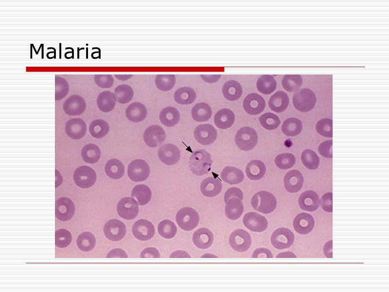 Malaria